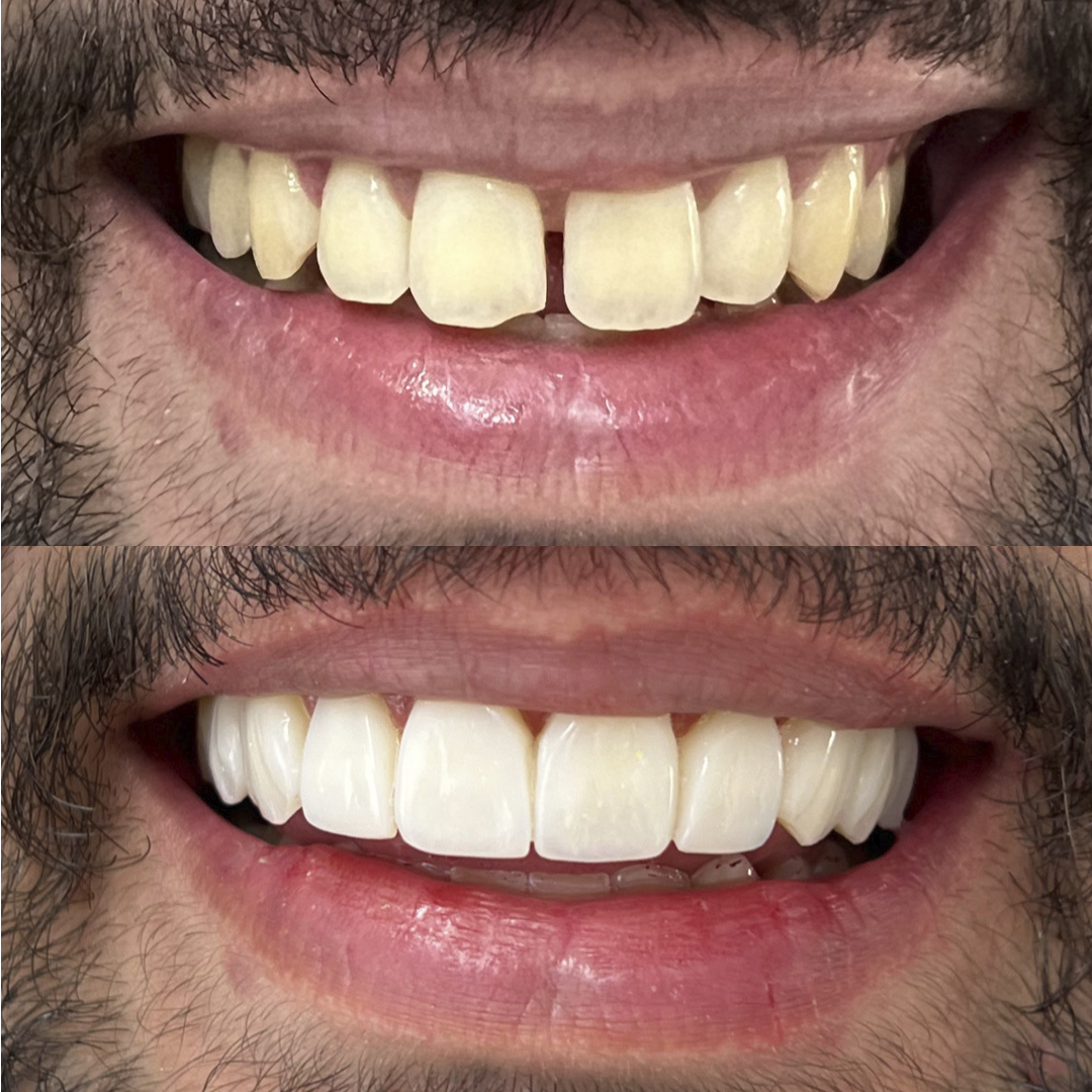 Antes e Depois - 01