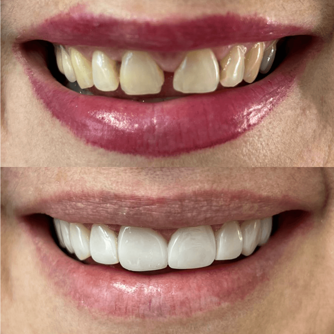 Antes e Depois - 02