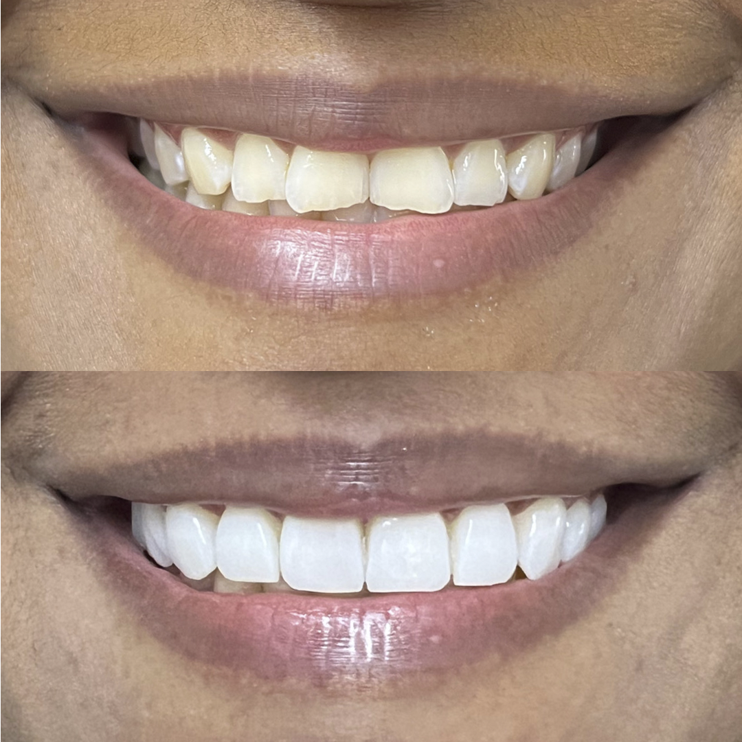 Antes e Depois - 03
