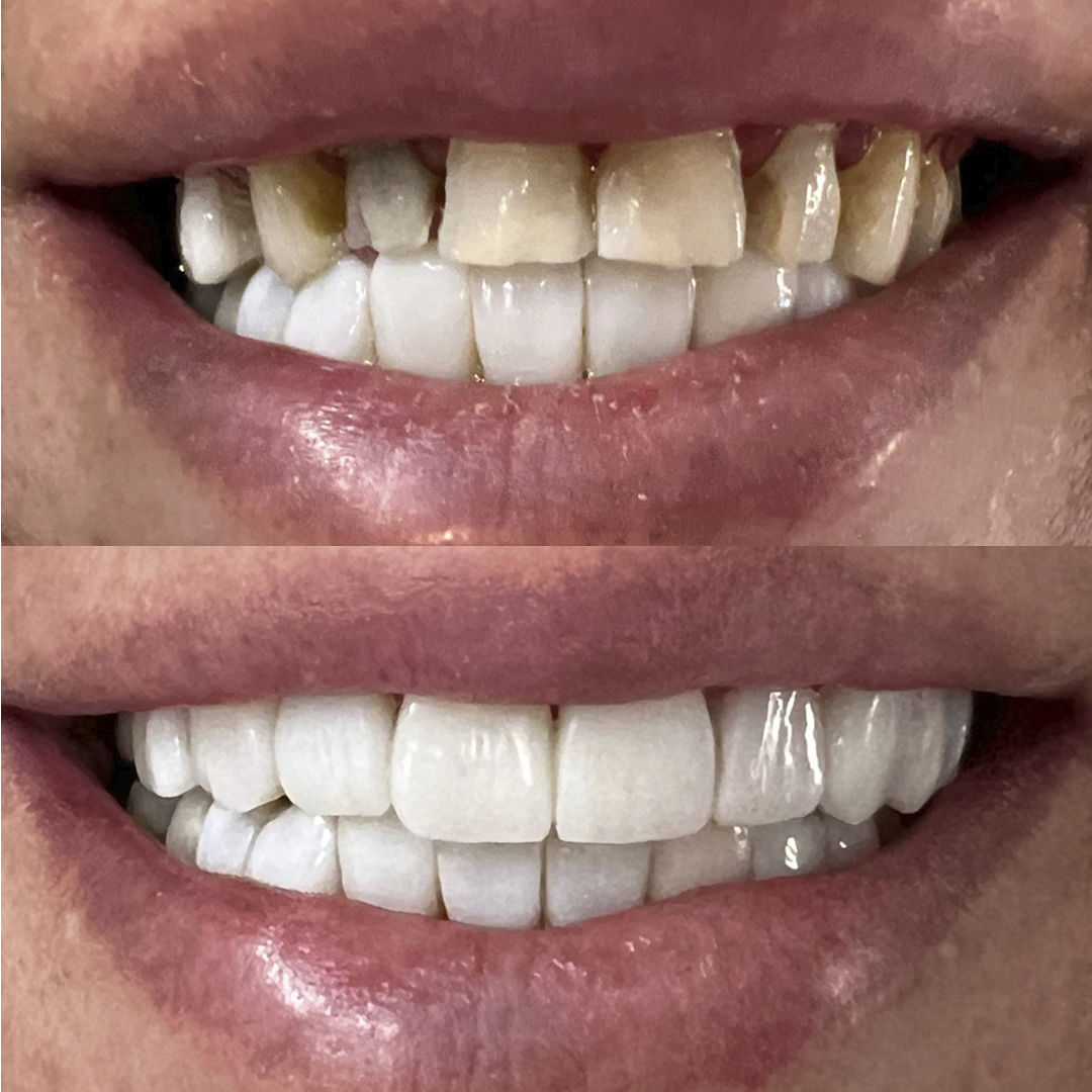 Antes e Depois - 04