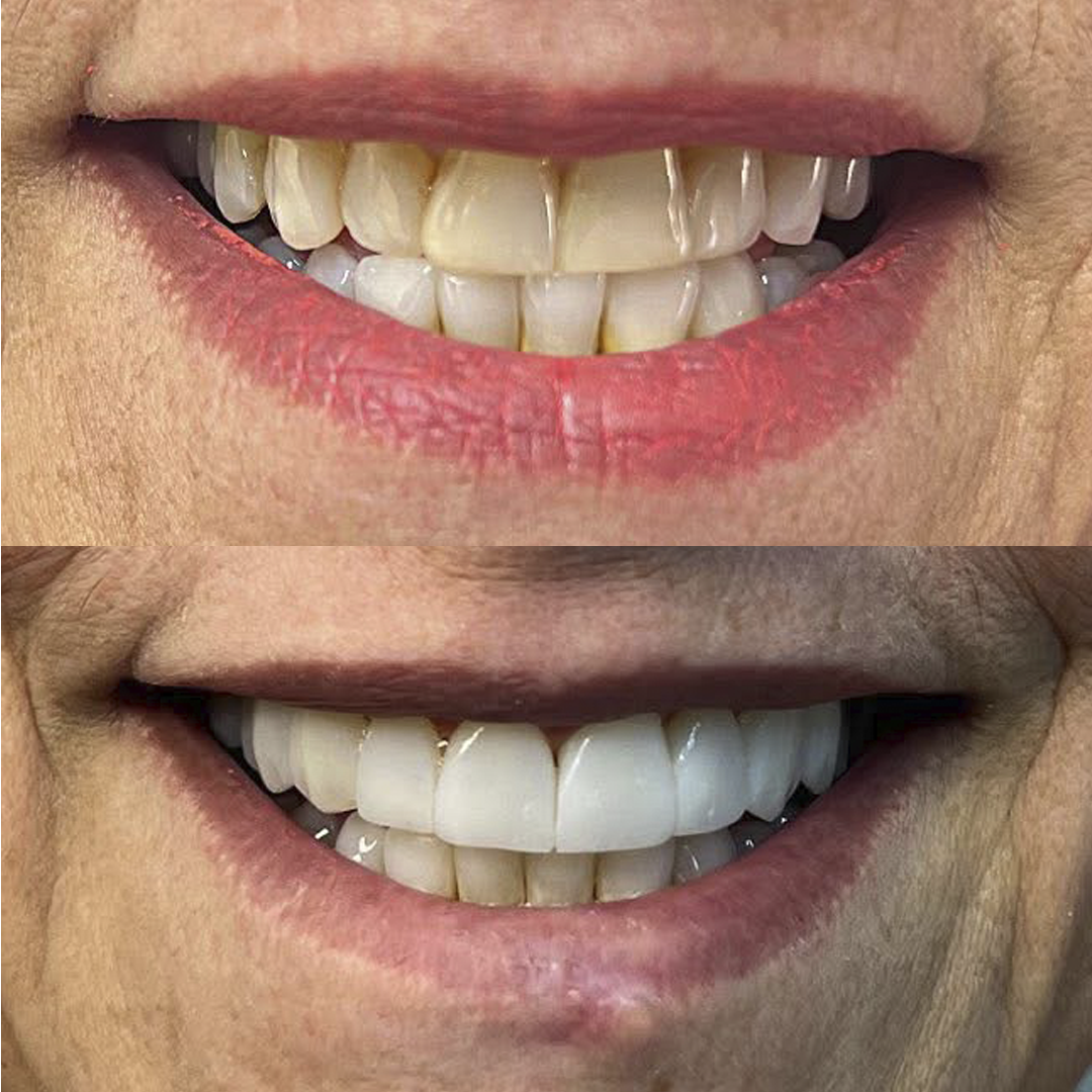 Antes e Depois - 05